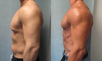 Gynecomastia 