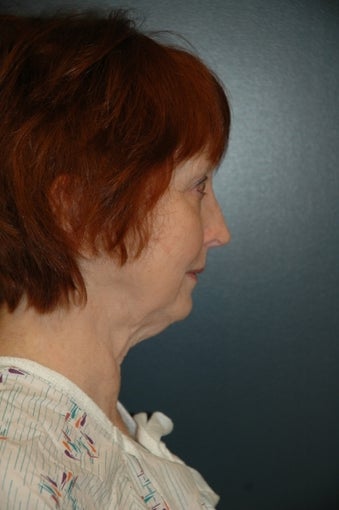 Facelift