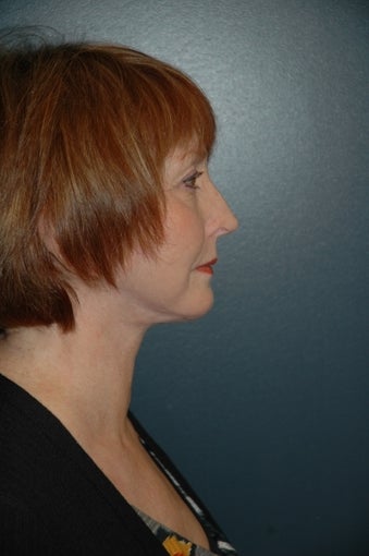 Facelift