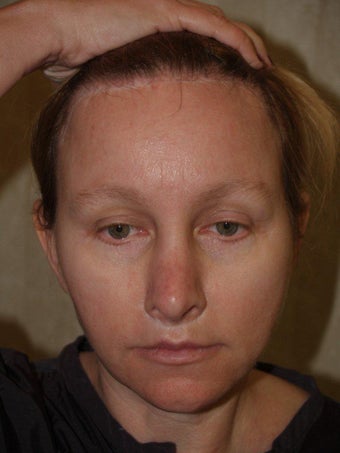 Hairline Transplant