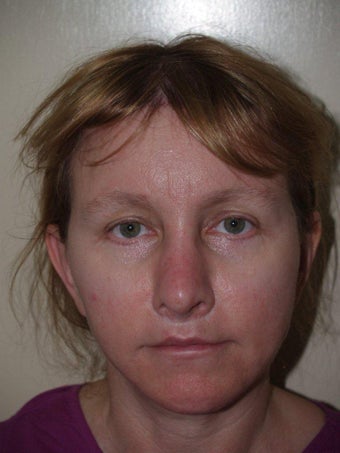 Hairline Transplant
