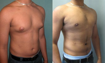 Gynecomastia 