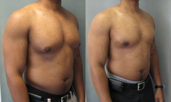 Male Breast Reduction 