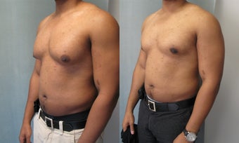 Male Breast Reduction 