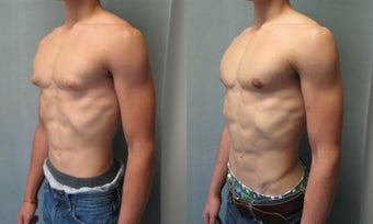 Gynecomastia