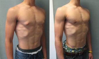 Gynecomastia