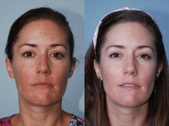 Cosmion Mask and M2 Treatment of Melasma