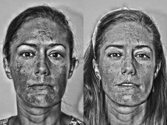 Cosmion Mask and M2 Treatment of Melasma