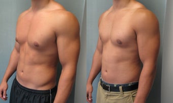 Gynecomastia 