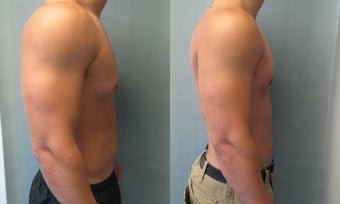 Gynecomastia 