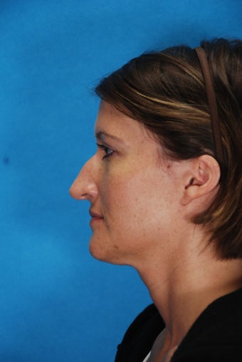 Rhinoplasty