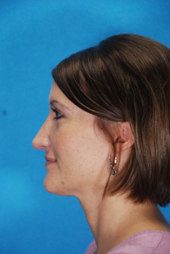 Rhinoplasty
