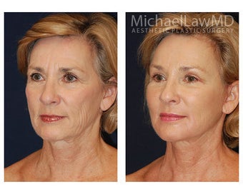 Neck Lift