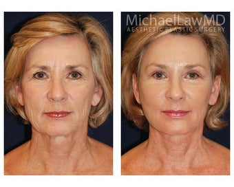 Neck Lift
