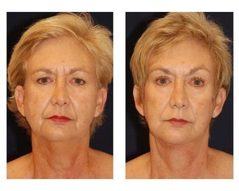 Neck Lift