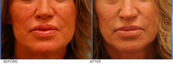 Lip Reduction for Correction of Silicone