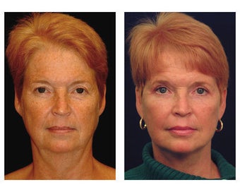 Lower Face and Neck Lift