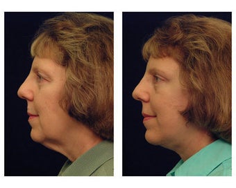 Lower Face and Neck Lift