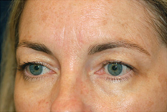 Eyelid Surgery/Fat Transfer