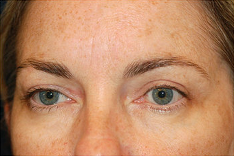 Eyelid Surgery/Fat Transfer