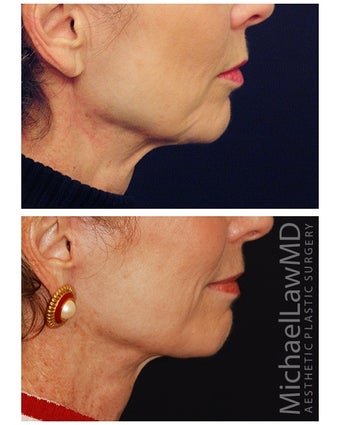 Lower Face and Neck Lift