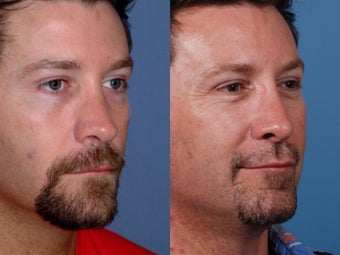 Revision rhinoplasty