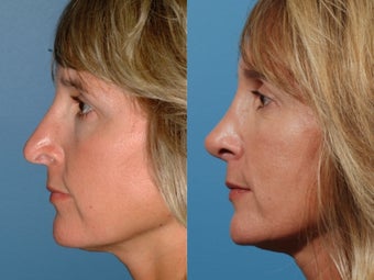 Revision rhinoplasty