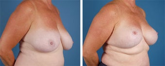 Breast Lift