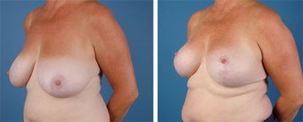 Breast Lift
