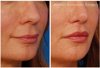 Lip lift