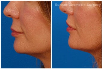 Lip lift