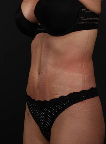 Full tummy tuck revision