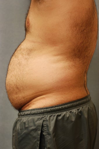SmartLipo Abs 