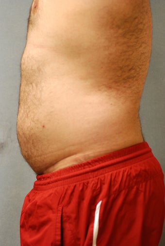 SmartLipo Abs 