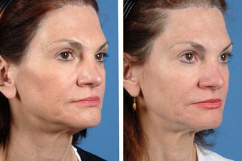 Fillers and Botox Cosmetic