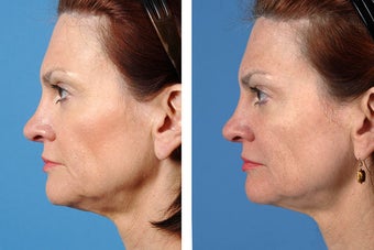 Fillers and Botox Cosmetic