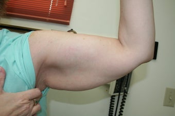 Brachioplasty - arm lift