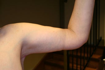 Brachioplasty - arm lift