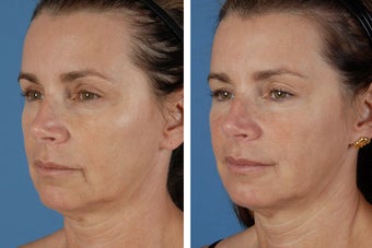 Radiesse & Botox Cosmetic