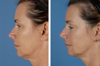 Radiesse & Botox Cosmetic