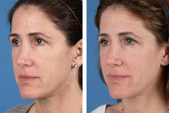 Juvederm Ultra, Restylane & Dysport