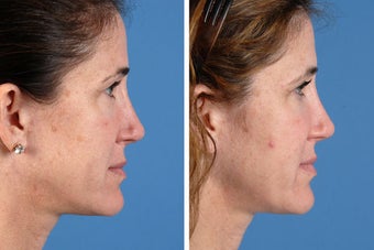 Juvederm Ultra, Restylane & Dysport