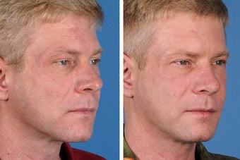Radiesse, Restylane, Juvederm Plus & Botox Cosmetic