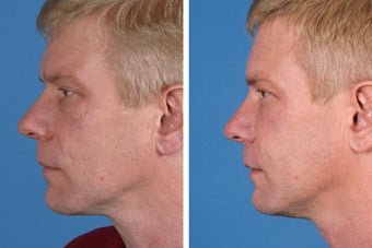 Radiesse, Restylane, Juvederm Plus & Botox Cosmetic