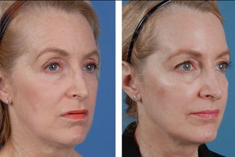 Restylane and Botox Cosmetic