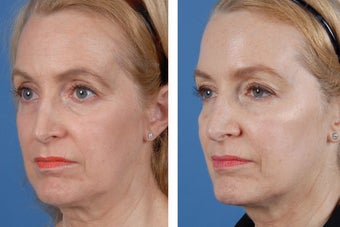 Restylane and Botox Cosmetic