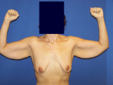 Arm Lift