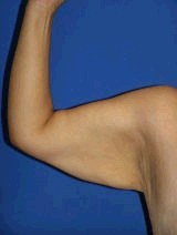 Arm Lift