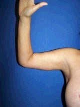 Arm Lift