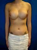 Revision Breast Surgery
